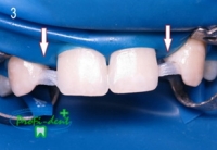 Восстановление отсутствующего зуба при помощи адгезивного моста