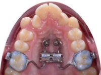 Скелетное расширение в ортодонтии или аппараты MSE (MARPE) 